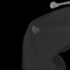 SPORK, NICO - 22.03.1976 - 02.08.2022 - CT obere Extremität - 17:59:07